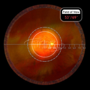 Volk 28D Large Aspheric Lens, Clear, with Green Ring