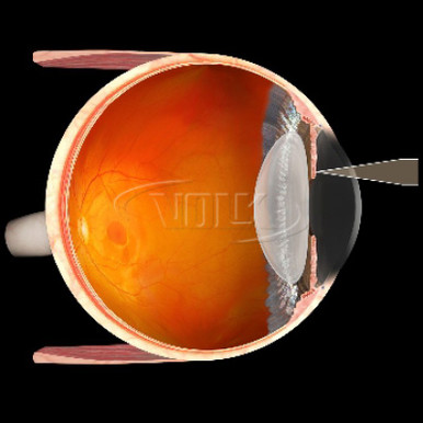 Volk Mag Plus Iridectomy Lens, view 2