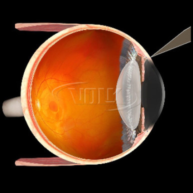 Volk Blumenthal Suturelysis Lens, view 2