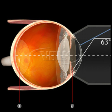 Volk Selective Laser Trabeculoplasty (SLT) Lens