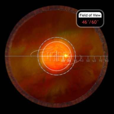 Volk 20D Large Aspheric Lens, Clear, with Purple Ring, view 3