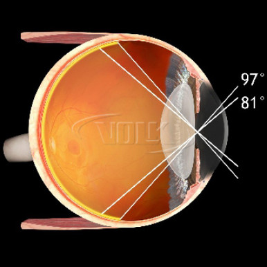 Volk 78D Small Aspheric Lens, Clear, with Green Ring