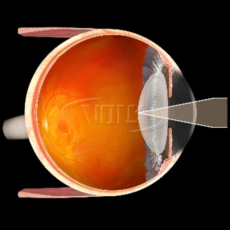 Volk Capsulotomy Lens, view 3