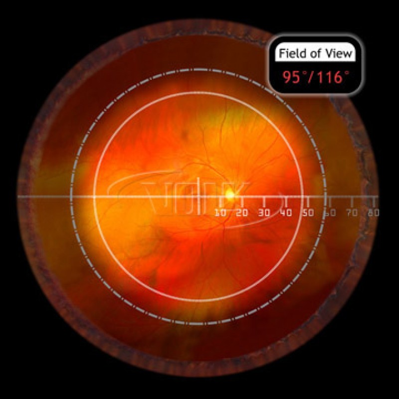 Volk VSFNC SuperField NC Lens, with Black Ring, view 2