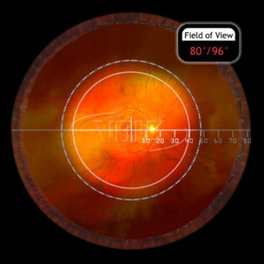 Volk VS66 Super66 Fundus Lens with Green Ring, view 3