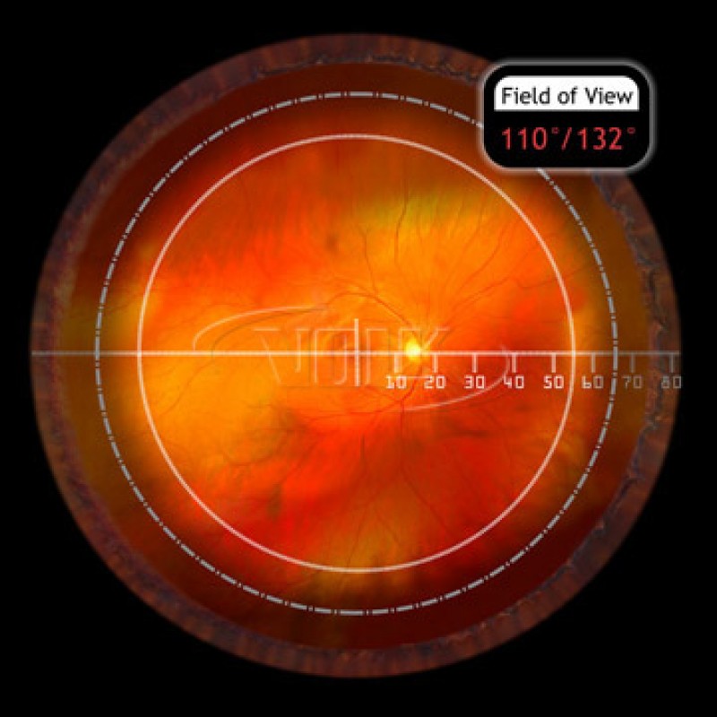 Volk VTE TransEquator Fundus Laser Lens, with Black Ring, view 4