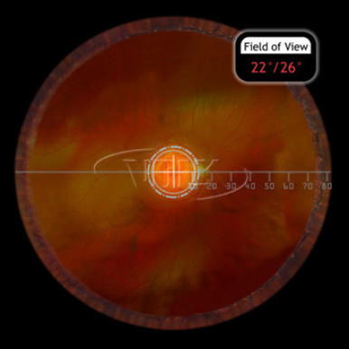 Volk VCDANF+ Centralis Direct ANF Lens (New Design), with Black Ring, view 3