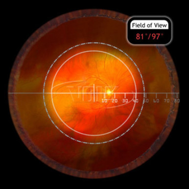 Volk 78D Small Aspheric Lens, Clear, with Green Ring, view 2